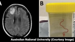 Un gusano de 8 centímetros ha sido encontrado vivo en el cerebro de una mujer en Australia.
