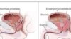 Ingcwethi Kwezempilakahle Zikhuthaza Abesilisa Abaleminya Esukela Ku40 Ukuyahlolwa Izitho Zabo Zangasese Ukuthi Azila Prostate Cancer