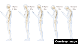 This chart shows the stress put on the neck and spine as a result of hunching over a smartphone. (Courtesy Dr. Ken Hansraj M.D.)