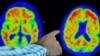 Un médico señala evidencia de la enfermedad de Alzheimer en exploraciones PET en el Centro de Investigación y Tratamiento del Alzheimer (CART) en el Hospital Brigham And Women's en Boston, Massachusetts, EE. UU., 30 de marzo de 2023. REUTERS/Brian Snyder/