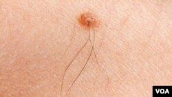 WHO melaporkan antara 2-3 juta kasus kanker kulit melanoma yang dilaporkan setiap tahun (foto: ilustrasi).
