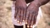 Des cas de variole du singe recensés en Côte d'Ivoire et au Kenya
