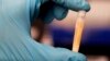 New Urine Test Offers Quick, Painless Check for Malaria