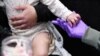 Measles: What to know, how to avoid it