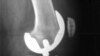 Promising new research suggests knee replacements like this might not be necessary in the future.