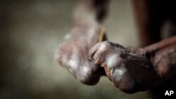 Tangan mantan penderita kusta. Badan Kesehatan Dunia (WHO) menyerukan tindakan untuk mengatasi penyakit-penyakit tropis terabaikan, salah satunya kusta, yang telah menimbulkan dampak pada sekitar 1,65 miliar orang di seluruh dunia. (Foto: AP)