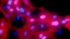 Immunotherapy Shows Progress Against Breast Cancer