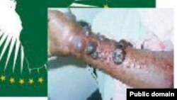 Cutar Ebola.