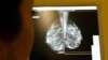 Study: Breast Cancer Drug Could Have Wider Use 