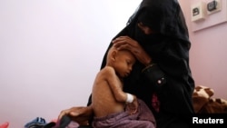 Seorang ibu menggendong bayinya yang mengalami malnutrisi akut di rumah sakit Sanaa, Yemen (foto: dok). Pandemi memaksa 93 juta lebih orang jatuh dalam kemiskinan ekstrem, dan lebih banyak yang jatuh ke dalam kelaparan parah.