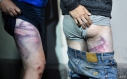Opositores a Alexander Lukashenko liberados el viernes muestran los hematomas por los golpes recibidos.