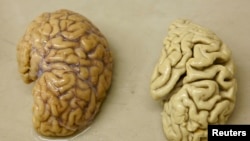FILE - One hemisphere of a healthy brain (L) is pictured next to one hemisphere of a brain of a person suffering from Alzheimer disease.