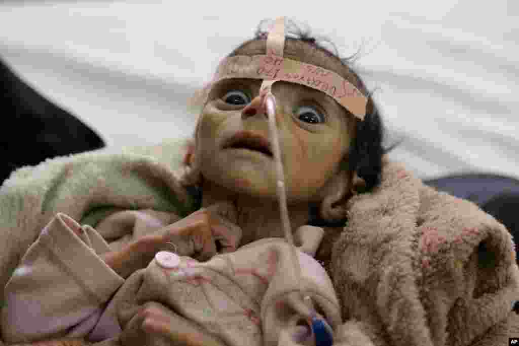 Infant Udai Faisal, who suffered from acute malnutrition, is hospitalized at Al-Sabeen Hospital in Sana'a, Yemen, March 22, 2016. Udai died on March 24. Hunger has been the most horrific consequence of Yemen’s conflict and has spiraled since Saudi Arabia and its allies, backed by the U.S., launched a campaign of airstrikes and a naval blockade a year ago.