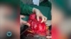 Fibroids zinavyoleta athari katika afya ya uzazi kwa wanawake