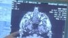 Study: Traumatic Brain Injury Patients at High Risk for Depression