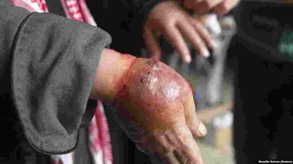 Un homme avec des mains présentant des symptômes de la leishmaniose, attend d'être soigné dans un hôpital à Alep, le 11 Février 2013. (SYRIA - Tags: HEALTH CIVIL UNREST) - RTR3DN52